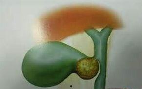 角瓜能治胆结石吗怎么吃,天然良方，巧治胆结石的饮食之道